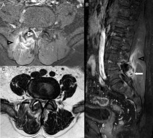 MRI of the lumbar spine consistent with facet joint septic arthritis of right L4–L5. Axial (A) and sagittal (B) T1-weighted fat-suppressed image with intravenous contrast. Axial T2-weighted image (C). Joint effusion (black arrow) and a small collection (white arrow) located behind the facet joint is observed. The adjacent paraspinal musculature shows inflammatory changes (black arrowheads). In the posterior and lateral right epidural space, a thickening and contrast enhancement is observed (white arrowhead), due to adjacent focal meningitis.