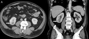 Abdominal CT scan showing findings consistent with right focal pyelonephritis. Axial (A) and coronal (B) image with intravenous contrast in nephrographic phase. A focal hypodensity with poorly defined borders (white arrows) is observed in the lower end of the kidney, affecting the cortex and medulla.