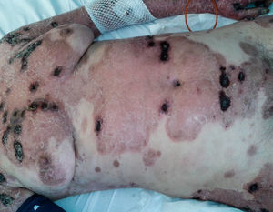 Generalised necrotic ulcers on psoriatic plaques 72h after admission.