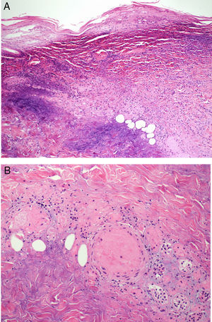 (A) Skin biopsy of one of the necrotic ulcers showing necrosis of the superficial and deep dermis, with a large inflammatory dermal component. (B) On enlargement of the image, in addition to the necrosis and the polymorphonuclear inflammatory infiltration, we can observe dermal blood vessels with vascular thrombosis, associated with the inflammatory process.