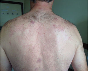 Skin lesions in cervical region, back, and upper limbs.