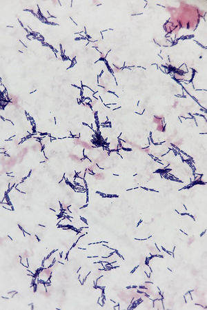 Gram statining of one hemoculture (1000×). The presence of gram-positive, non-sporulating bacilli with a tendency to make short chains is consistent with the Lactobacillus rhamnosus bacteria.