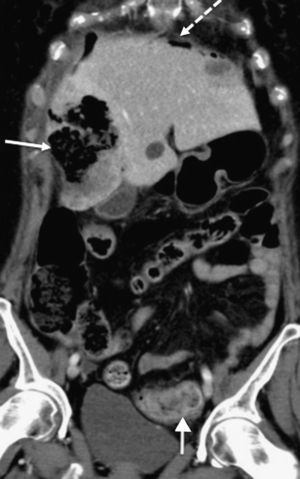 CT scan of abdomen (coronal oblique plane) with intravenous contrast. Necrotic and abscessed liver metastases (continuous arrow with solid head) complicated by pneumoperitoneum (dotted arrow) and associated with neoplasm-related thickening in sigmoid colon (continuous arrow with open head).