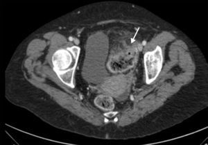 CT scan of pelvis (axial plane) with intravenous contrast. Thickening of wall with appearance suggestive of neoplasm in sigmoid colon with infiltration of mesenteric fat (white arrow).