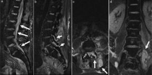 Magnetic resonance images: (a) D12-S1 peridural abscess, (b) L4-L5-S1 lumbar facet arthritis, (c) L5-S1 articular destruction with periarticular abscess and (d) left iliopsoas abscess.