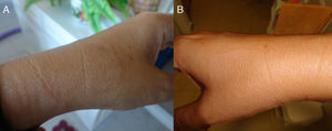 Photos of symmetrical hypochromic macules with erythematous borders on both wrists (after 18 months). (A) Macule on left wrist. (B) Macule on right wrist.