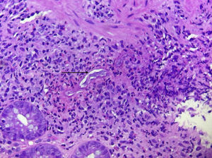 Colon biopsy (case 2) showing Strongyloides larvae (arrow).