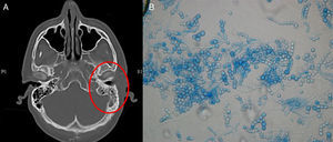 Main diagnostic signs of otitis externa due to Scopulariopsis brevicaulis. (A) Head CT showing opacification of the mastoid cells and chondritis of the EAC, on the left side. (B) Lactophenol blue staining (40×) after 7 days of incubation: spherical conidia with truncate base in chains.