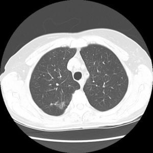 CT after treatment.