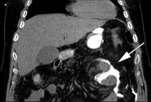 CT slide showing the oral contrast extravasation (arrow) into the abdominal cavity.