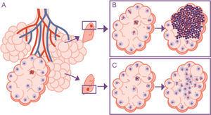 Importance of the location of the infection in the upper lobes. The infection takes place in a pulmonary alveolus (A) but the progression is different in the upper lobe, where the accumulation of bacilli means that the alveolar macrophages (AMs) must deal with a higher quantity of bacilli, generating a response preferentially based on the accumulation of PMN cells (B). In contrast, in the lower lobe, more significant drainage allows a greater distribution of bacilli and an inflammatory response based on the accumulation of AM and monocytes (C).