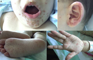 (A) Lesion in the perioral zone and nasal cavity covered by meliceric scabs suggestive of impetiginization. (B and D) Palmoplantar affectation. (C) Significant lesion damage to the auricular pavilion.