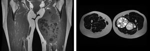 Magnetic resonance imaging: multiple space-occupying lesions in the left thigh.