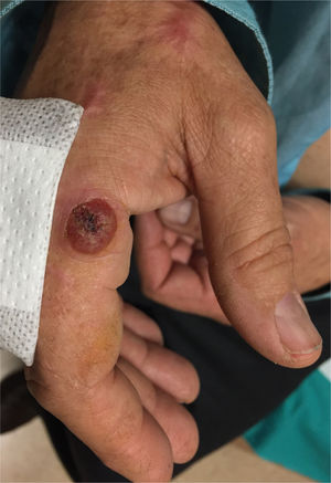 Evolved skin lesion on the right hand.