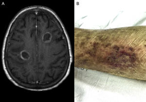 Magnetic resonance imaging of the brain (A) and cutaneous lesions (B) noted in patient's left thigh.