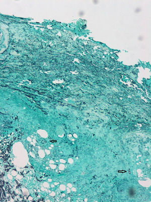 Grocott–Gömöri stain at 100× magnification. The arrows indicate thick-walled, aseptate fungal structures compatible with Mucorales.