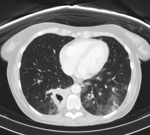 Chest CT scan. Infiltrates in both lower lobes and cavitated consolidation in the right lower lobe.