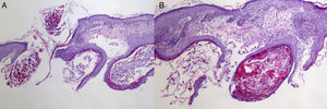 (A) Panoramic view of molluscum contagiosum infection's follicular involvement, observing follicular epithelium lobes which penetrate the dermis where the characteristic inclusion bodies of the virus are seen. (B) At a higher magnification, we can see in detail how these inclusion bodies increase in size from the more basal layers to the more superficial layers, becoming more basophilic.