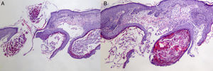 (A) Panoramic view of molluscum contagiosum infection