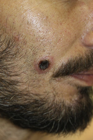 Ulcerated lesion with necrotic centre on the right cheek.
