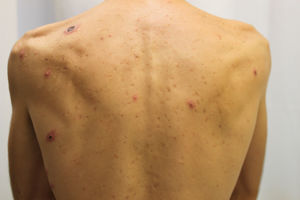 Erythematous papules and more advanced ulcerated lesions on the torso.