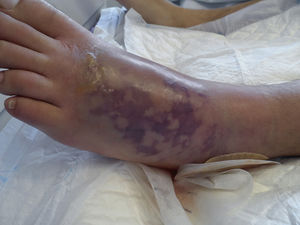 Lesion of left foot with development of livedo reticularis.