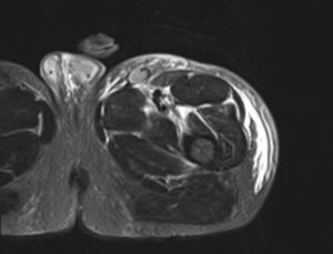 MRI showing interfascial oedema.