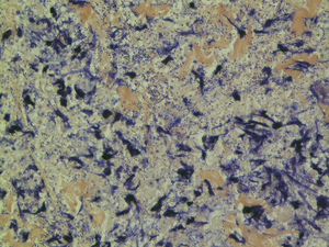 Histology image of thigh biopsy with fasciitis.