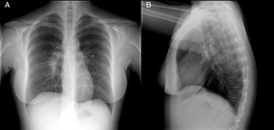 (A) Posteroanterior chest X-ray. (B) Lateral chest X-ray. Right hilar enlargement related to lymphadenopathy.