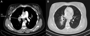 Axial images from chest CT scan with intravenous contrast. (A) Mediastinal window. (B) Lung window showing paratracheal, hilar, intrapulmonary and subcarinal right lymphadenopathy of a pathological size, measuring up to 2.9cm.