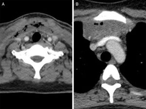 Cervical CT image (A) showing collections of air and fluid in the anterior cervical region as well as chest CT image (B) showing a mediastinal collection.