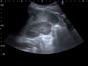 Hypodense lesions on the periphery of the spleen with a wedge-shaped morphology towards the centre, giving an impression of splenic infarctions.