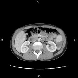 The patient was confirmed to have splenic lesions given the appearance of multiple hypodense images with a wedge-shaped morphology throughout the spleen, from the periphery to the splenic hilum, suggesting splenic infarctions as a leading possibility. Moderate splenomegaly (13cm×14.5cm).