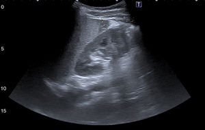 Follow-up ultrasound showing exclusively a small hypodense lesion measuring around 12–13mm on the inferior splenic pole.