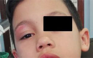 Significant improvement with healing of the lesion on the upper eyelid a week after the initial assessment. The patient was receiving treatment with oral amoxicillin–clavulanic acid at home.