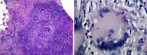 Histology image: (a) a necrotising granulomatous infiltrate (haematoxylin–eosin staining) and (b) acid alcohol fast bacilli (arrow; Ziehl–Neelsen staining) are seen.