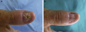 Clinical appearance (a) 4 months and (b) 5 months after starting tuberculostatic treatment.