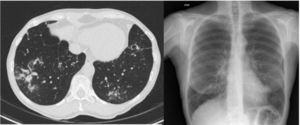 Patient 3. Computed tomography scan and chest X-ray: bronchiectasis in upper lope, middle lobe and lingula; nodules in left lower lobe.