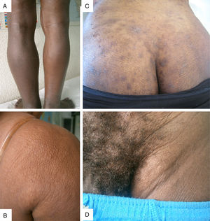 Representative clinical pictures of onchocerciasis (A) sowda and lymphedema; (B) orange skin; (C) chronic papular onchodermatitis (CPOD); (D) haning groin.