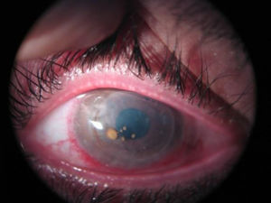 Bright, brownish nodular lesions attached to the centre of the corneal surface on examination with ophthalmic biomicroscope (slit lamp).