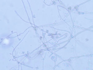 Thick, irregular hyphae with hyaline or light brown, single-cell conidia, arranged in groups attached to the hyphae (lactophenol blue stain, 400×).