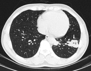 The chest CT scan showed nodular opacity of diffuse distribution in the left lower lobe (white arrow).