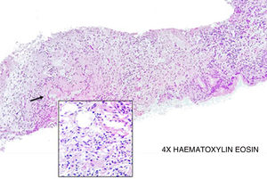 Hematoxylin eosin stain with lymphohistiocytic inflammatory infiltrate with presence of giant cells and formation of granulomas (black arrow).