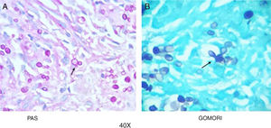 PAS (A) and Gomori (B) staining with multiple yeast cells in “ship