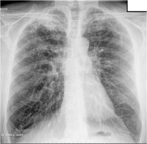 Anterior/posterior chest X-ray on admission: right apical infiltrate.