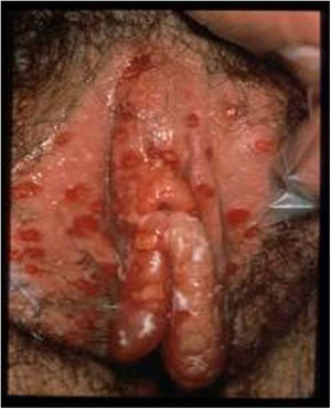 Ulcerative vulvar lesions. Adapted from Garland and Steben.13
