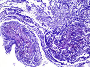 PAS staining. Multiple, tubular PAS-positive structures passing into the wall of a blood vessel are identified.