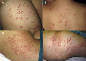 (A) Papules and multiple short serpiginous paths. (B) Predominance of the papular component on the upper part of the back. (C) Erythematous oedematous papules in the absence of sinuous paths. (D) Multiple lesions in different evolutionary stages.