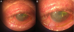 (A) Severe blepharitis. (B) Corneal ulcer stained with fluorescein on transplant.