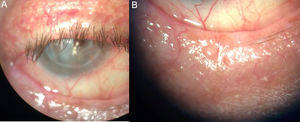 (A) Upper eyelid with absence of collarettes on the eyelashes. (B) Lower eyelid with madarosis and absence of secretions.